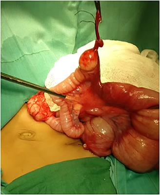 Case Report: Complicated Meckel Diverticulum Spectrum in Children